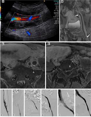 Catheter-Directed Thrombolysis for Postpartum Deep Venous Thrombosis